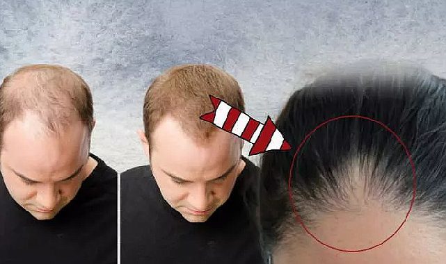 Kellik tarihe karışıyor! Japon bilim insanları çözdü