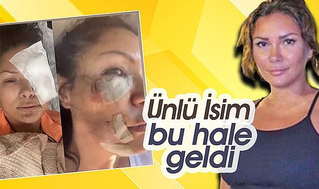 Tuğba Altıntop köpek saldırısı sonrası yüzüne onlarca dikiş atıldı
