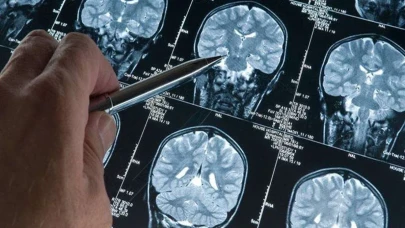 Alzheimer’da çığır açan buluş: Kan testiyle erken teşhis dönemi