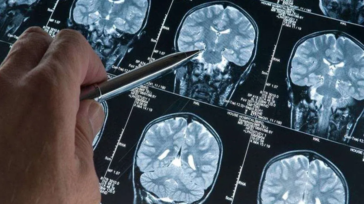 Alzheimer’da çığır açan buluş: Kan testiyle erken teşhis dönemi