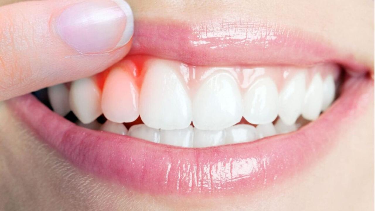 Ağız ve diş sağlığının temeli: Sağlıklı diş etleri