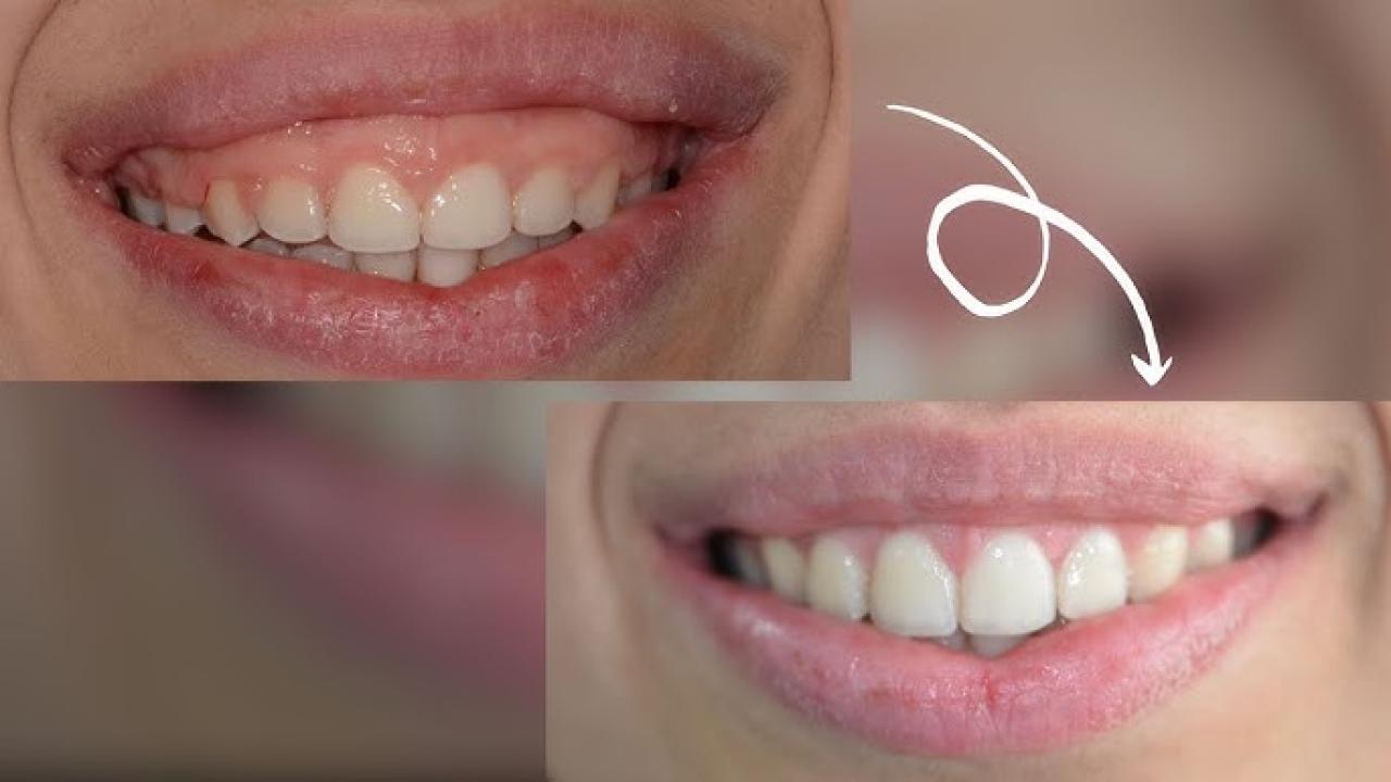 Pembe estetik: Gülüş estetiğinin sessiz kahramanı