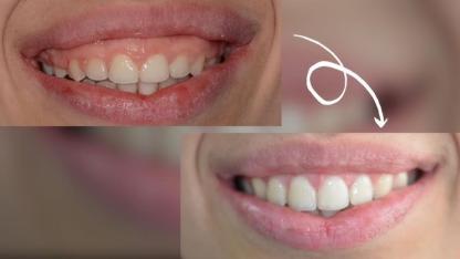 Pembe estetik: Gülüş estetiğinin sessiz kahramanı