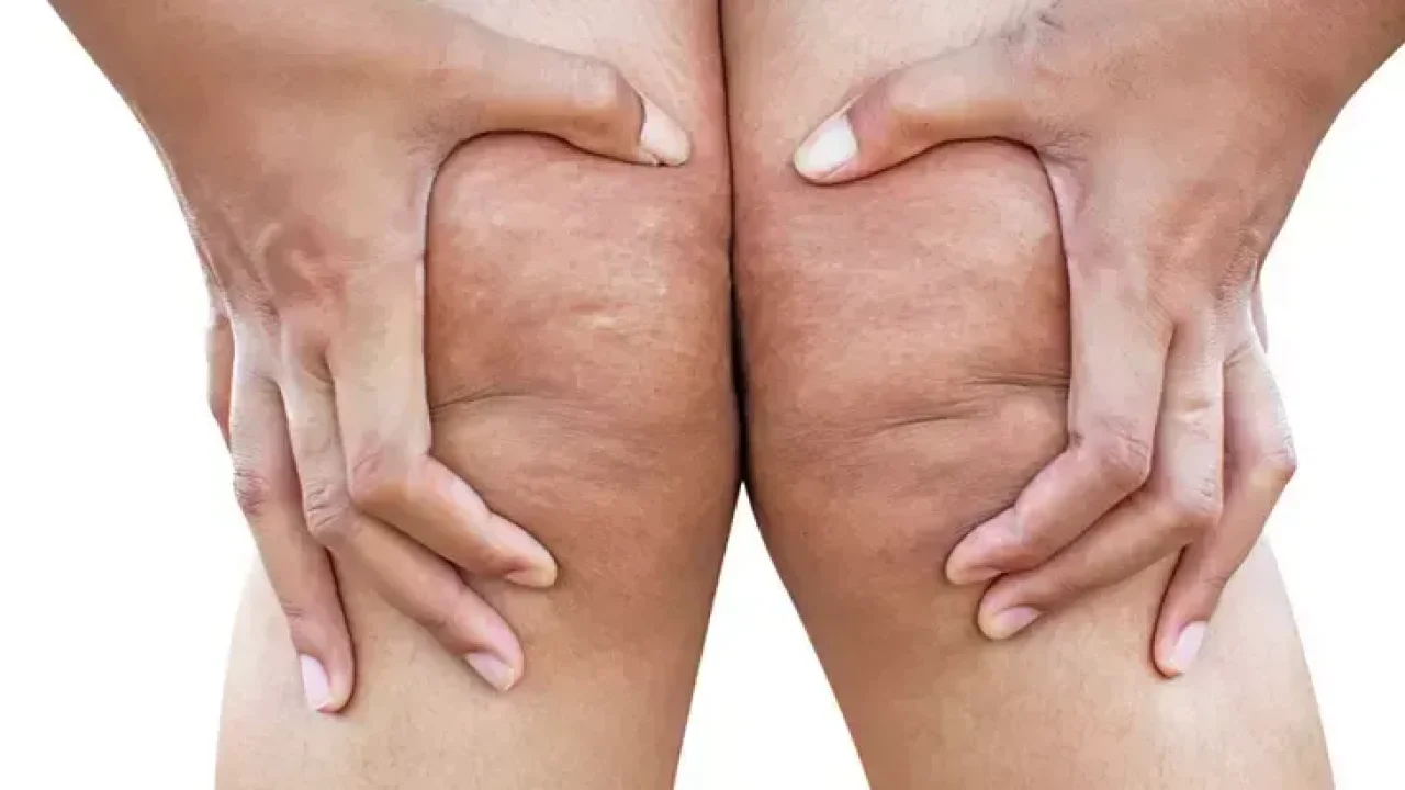 Ya kilolu değil de lipödemseniz?